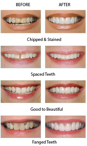 veneers-example