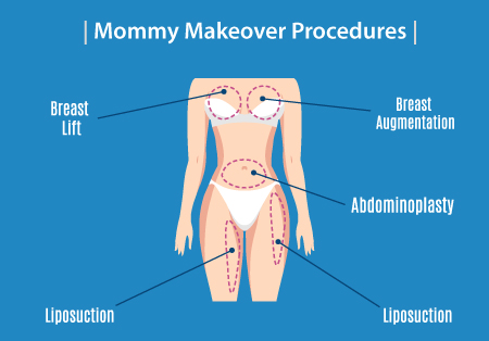 Mommy-Makeover-Procedures-Abdominoplasty-Breast-Implants-Breast-Lift-Liposuction-Infographic