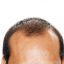 Hair loss - why does it happen and what treatment options are available