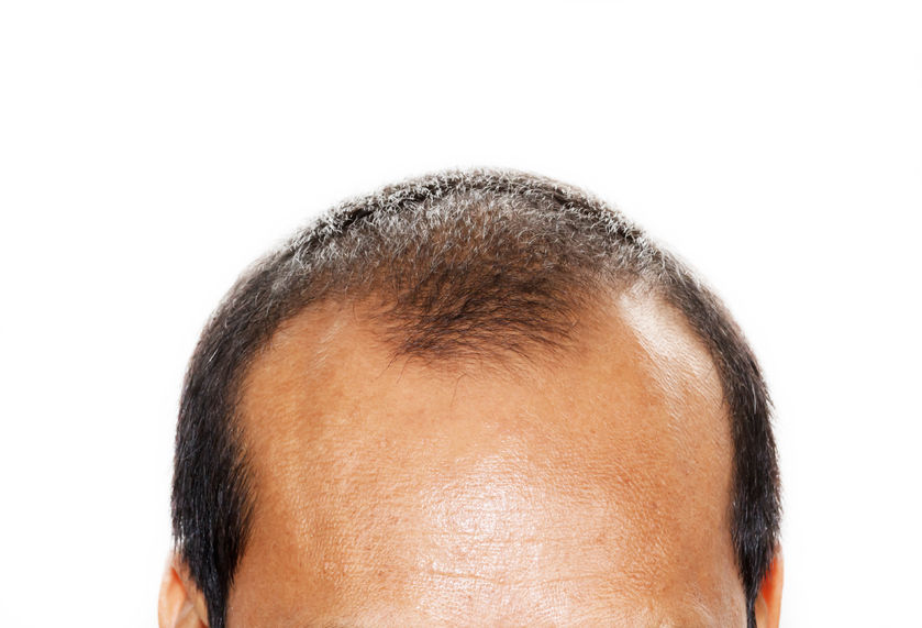 Hair loss - why does it happen and what treatment options are available