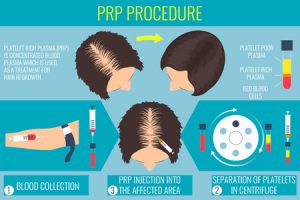 prp treatment overview