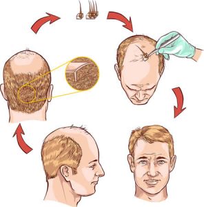 hair transplant overview vector
